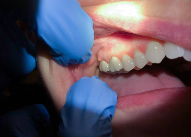 Best Emergency Treatment for Toothache in Humansville, MO